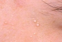 Виды прыщей и что они означают — ResedaOdor