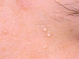 Виды прыщей и что они означают — ResedaOdor