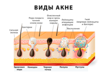 Можно ли давить прыщи и чем это грозит — ResedaOdor