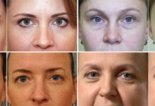 Папулы после биоревитализации: сколько дней держатся