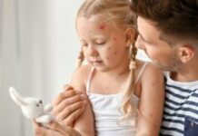 Ветрянка у ребенка: что нужно знать родителям, блог ОН Клиник