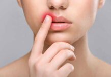 Герпес на губах: лечение герпеса на губе, как и чем лечить