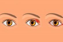 Что делать, если на глазу вскочил ячмень — Лайфхакер