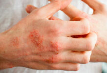 7 типов экземы – причины, симптомы, лечение — Профессорская клиника