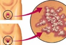Герпес в интимной зоне у женщин: симптомы, лечение, фото