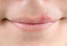 Герпес перед месячными: почему появляется, какое лечение
