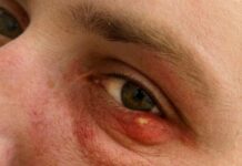 Как предотвратить ячмень на глазу на ранней стадии |