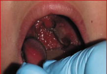 Острые тонзиллофарингиты — взгляд инфекциониста | #10/18 | «Лечащий врач» – профессиональное медицинское издание для врачей. Научные статьи.