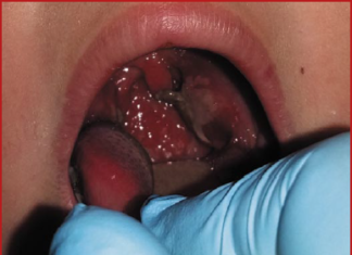 Острые тонзиллофарингиты — взгляд инфекциониста | #10/18 | «Лечащий врач» – профессиональное медицинское издание для врачей. Научные статьи.