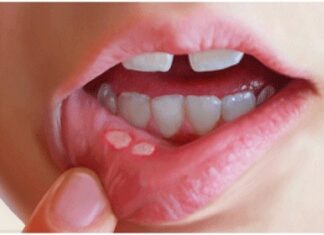 Методы лечения стоматита у детей — Городская Стоматология