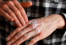 Сухая экзема — как лечить