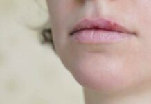 Какими мазями можно быстро вылечить герпес на губах. Как выбрать самую эффективную и при этом дешёвую мазь от герпеса на губах