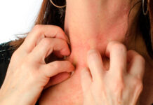 Микробная экзема — как лечить