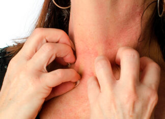 Микробная экзема — как лечить