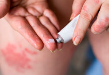 Экзема: причины и лечение