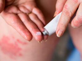 Проявления и лечение экземы, когда развивается боль — Терапия