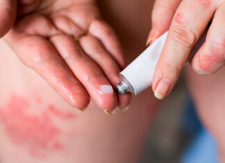 Проявления и лечение экземы, когда развивается боль — Терапия