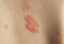 Опоясывающий герпес: симптомы, фото, лечение