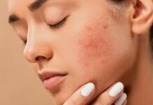 Как вылечиться от акне — блог медицинского центра ОН Клиник