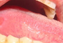 Язвы на языке: причины, как и чем лечить болячки на языке