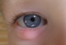 Можно ли идти в школу с ячменем на глазу?