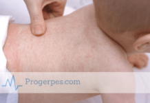 Розеола заразна или нет — мнение медиков