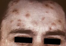 Папулы при сифилисе: почему образуются и как выглядят.