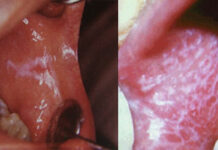 Красный Плоский Лишай Полости Рта; OHI-S