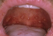 Стоматит у детей — симптомы и методы лечения, профилактика, фото