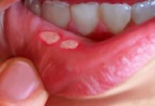 Стоматит (фото), лечение у взрослых в домашних условиях — эффективные препараты