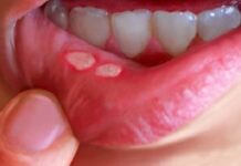 Герпетический стоматит в полости рта. Этиология, лечение, профилактика.