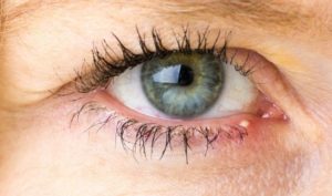 Ячмень — последствия нелечения, осложнения