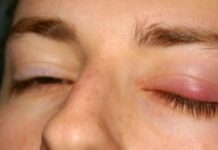 Профилактика ячменя на глазу