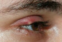Ячмень на верхнем веке — причины и лечение
