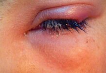 Ячмень на глазу у ребенка: симптомы, причины и лечение — Мой ребенок