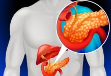 Панкреатит: воспаление поджелудочной железы — симптомы, лечение, диета