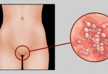 Генитальный герпес: проявления, диагностика, лечение