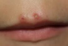 Абсцесс на губе: причины, лечение, профилактика