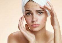 Гормональные причины появления акне