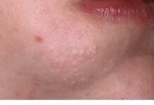 Акне, угри, комедоны — Инсайт Медикал Киев Позняки