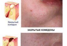 Премьер — Клиника эстетической медицины — Комедоны на лице – причины появления, виды и методы лечения