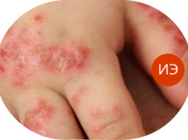 Экзема на руках: причины, симптомы, лечение, диагностика