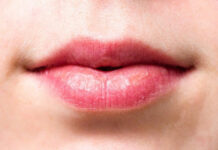 Как бороться с таким заболеванием губ, как хейлит