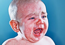 Если у ребенка экзема… — ЗдоровьеИнфо