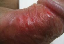 Язвочки на половом члене и на головке у мужчин: основные причины патологии, симптомы и методы диагностики, способы медикаментозного лечения и профилактики