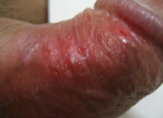 Язвочки на половом члене и на головке у мужчин: основные причины патологии, симптомы и методы диагностики, способы медикаментозного лечения и профилактики