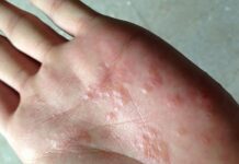 Экзема (мокнущий лишай). лечение, симптомы, мазь от экземы на руках и ногах — Поликлиника №8