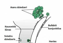 Что такое халязион и ячмень? Latvijas Amerikas acu centrs