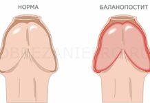 Баланопостит у мужчин: лечение, операция (ФОТО) | Меньщиков К. А.