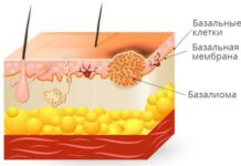 Базалиома кожи лица: лечение, как выглядит базалиома кожи лица, чем опасна базалиома кожи лица